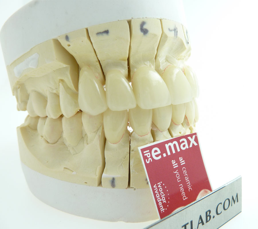 Flexible Denture